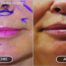 This patient had a lip lift and augmentation.