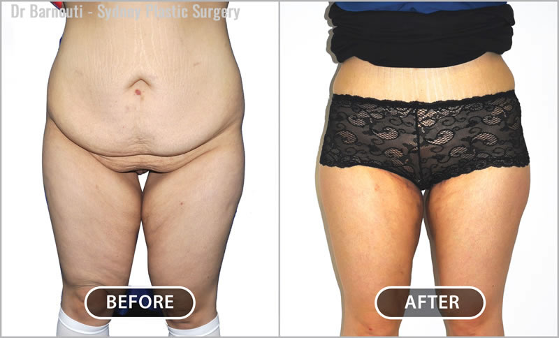Thigh Lift by Dr Barnouti - Sydney Plastic Surgery Before After Galleries