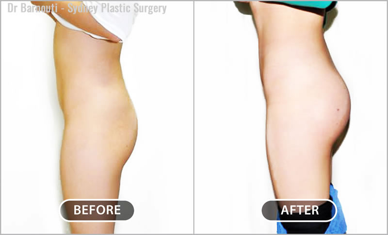 Buttock lift and Augmentation Before and After Gallery