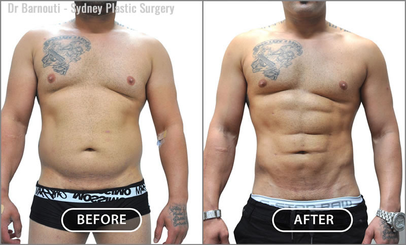 Abdominal Etching/Pectoral Implants/Liposculpture Before After Gallery