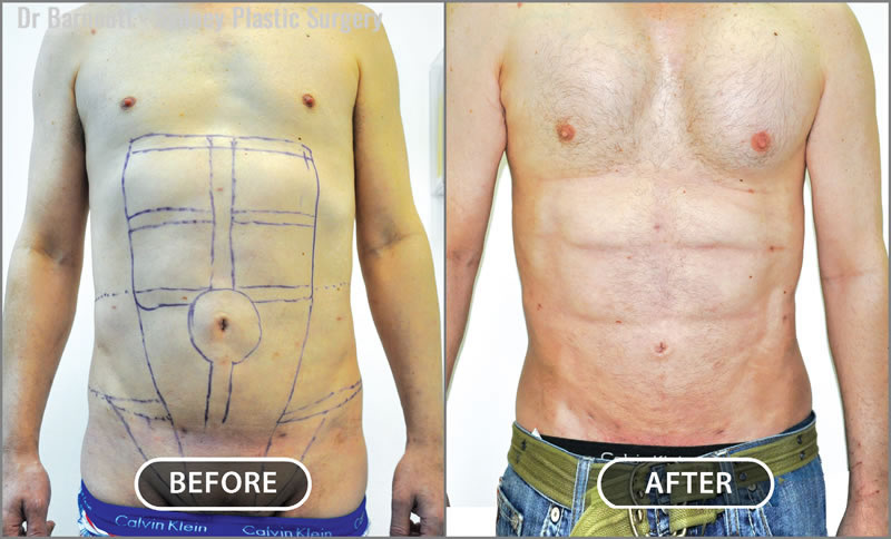 Abdominal Etching/Pectoral Implants/Liposculpture Before After Gallery