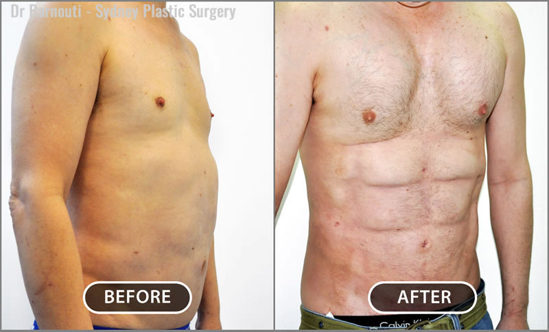 Abdominal Sculpting (6-pack) Before and After - Bluewater Plastic