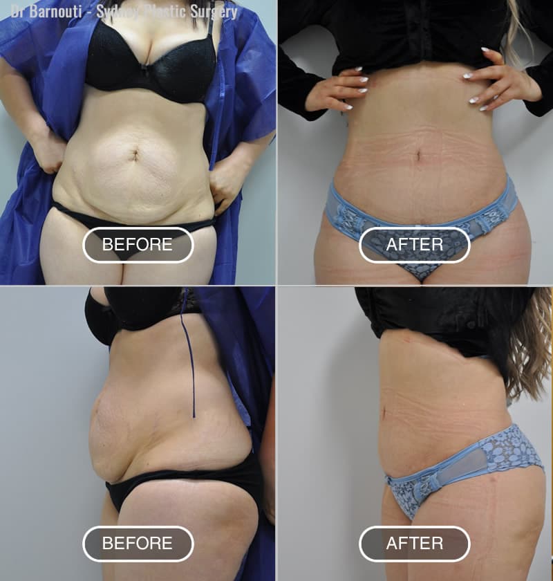 Abdominoplasty/Tummy Tuck Before & After Photo Gallery