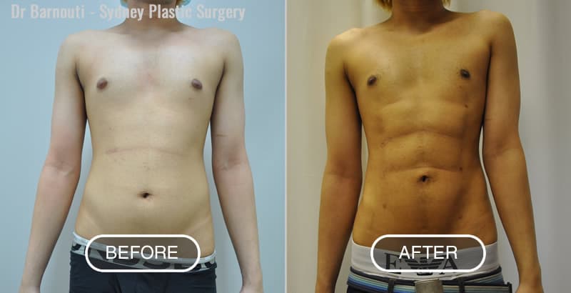 Difference Between Liposuction & Abdominal Etching