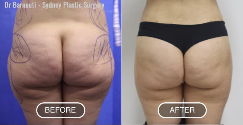 Buttock lift and Augmentation Before and After Gallery