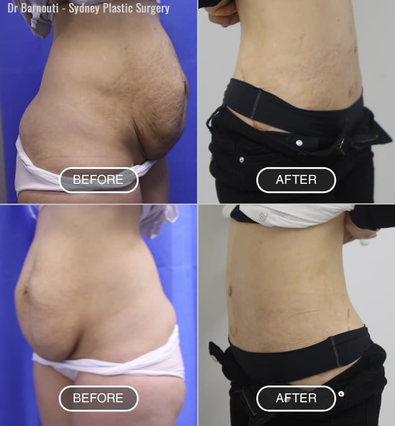Tummy Tuck - Dr. G Cosmetic Surgery