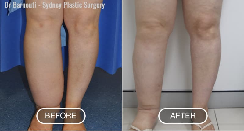 Before and after Right leg Lymphedema