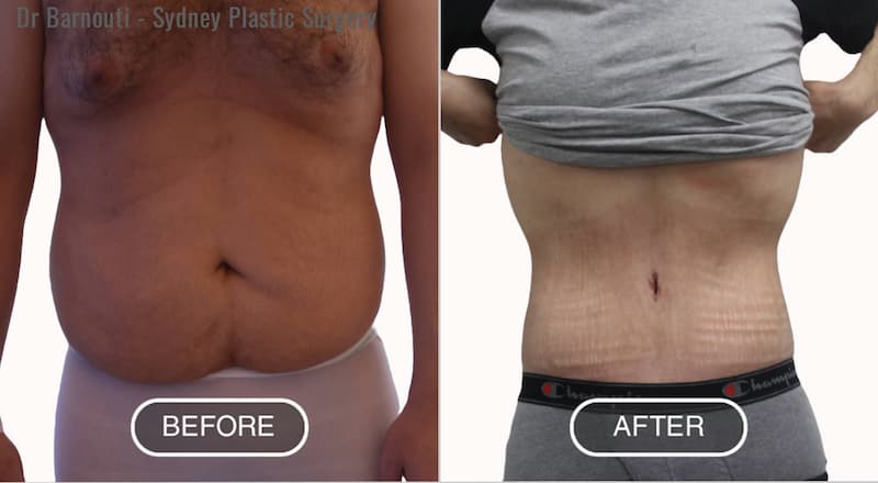 Abdominoplasty / Abdominal Etching Before-After