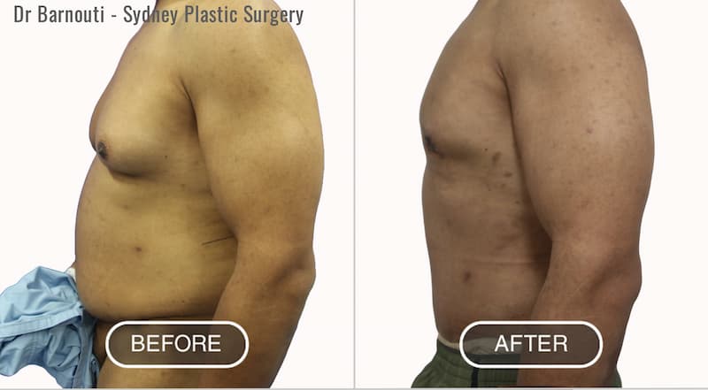 Abdominoplasty / Abdominal Etching Before-After