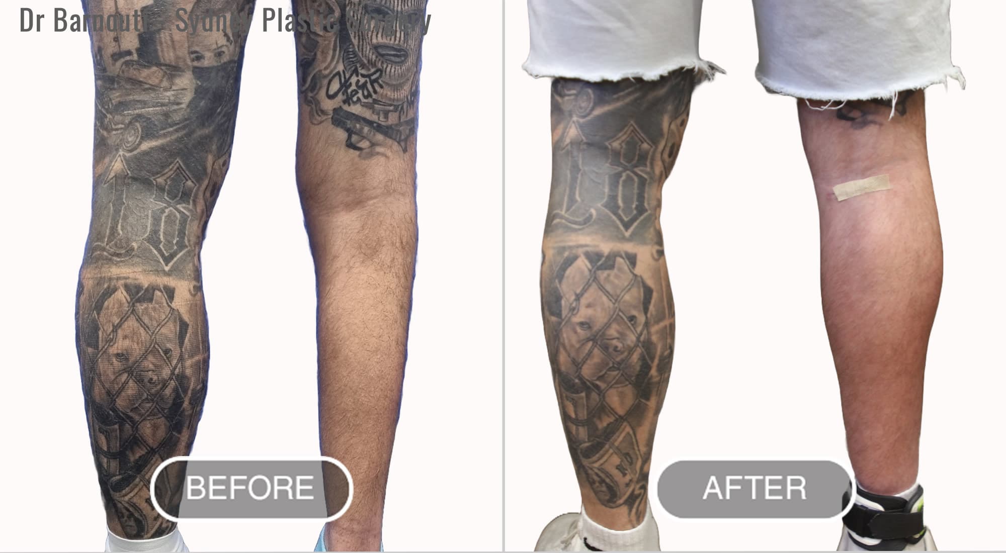 Calf Augmentation Before After