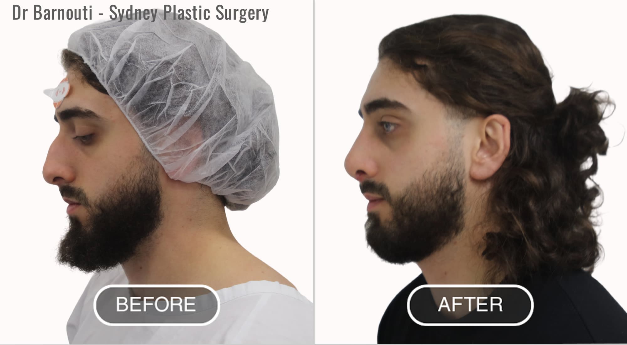 Rhinoplasty Before After