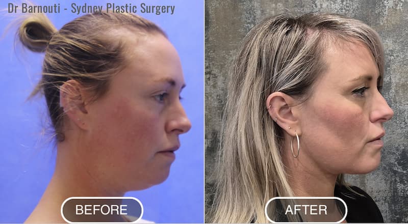 Neck liposuction and chin fat injection Before and After