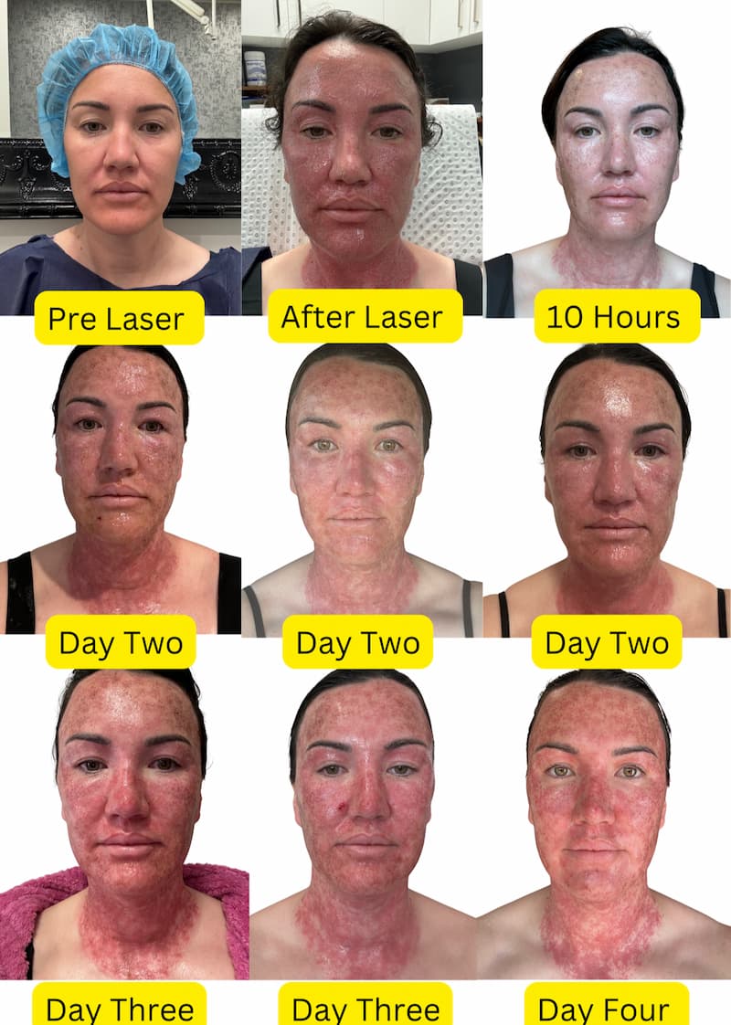 Fractional Laser