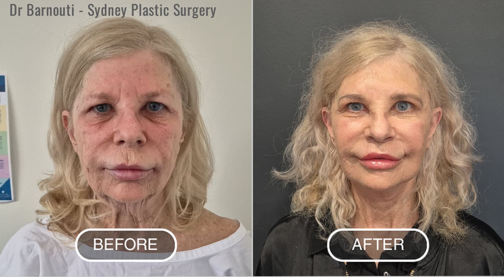 Before After Facelift